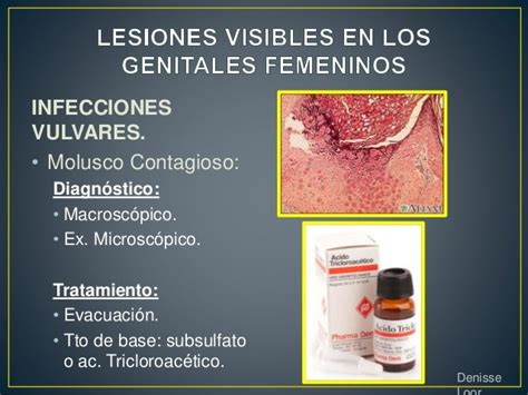 Llagas en genitales femeninos: Fotos, causas y diagnóstico